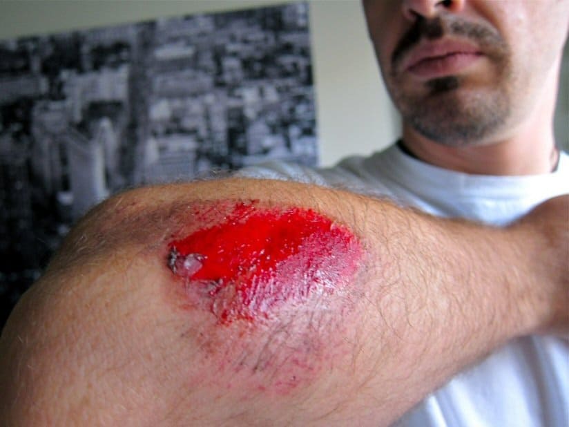 road-rash-824x618 NWCC Labor Day VP Ride - September 4, 2023 - St Arnold Brewery